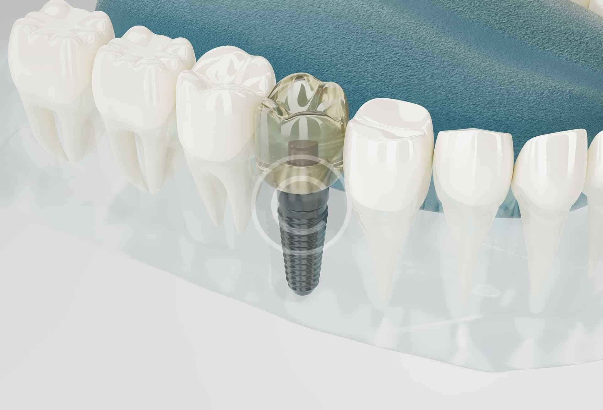 Implants